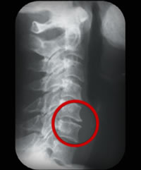 Adjacent joint surfaces become rough and uneven. Phase Two Spinal Decay